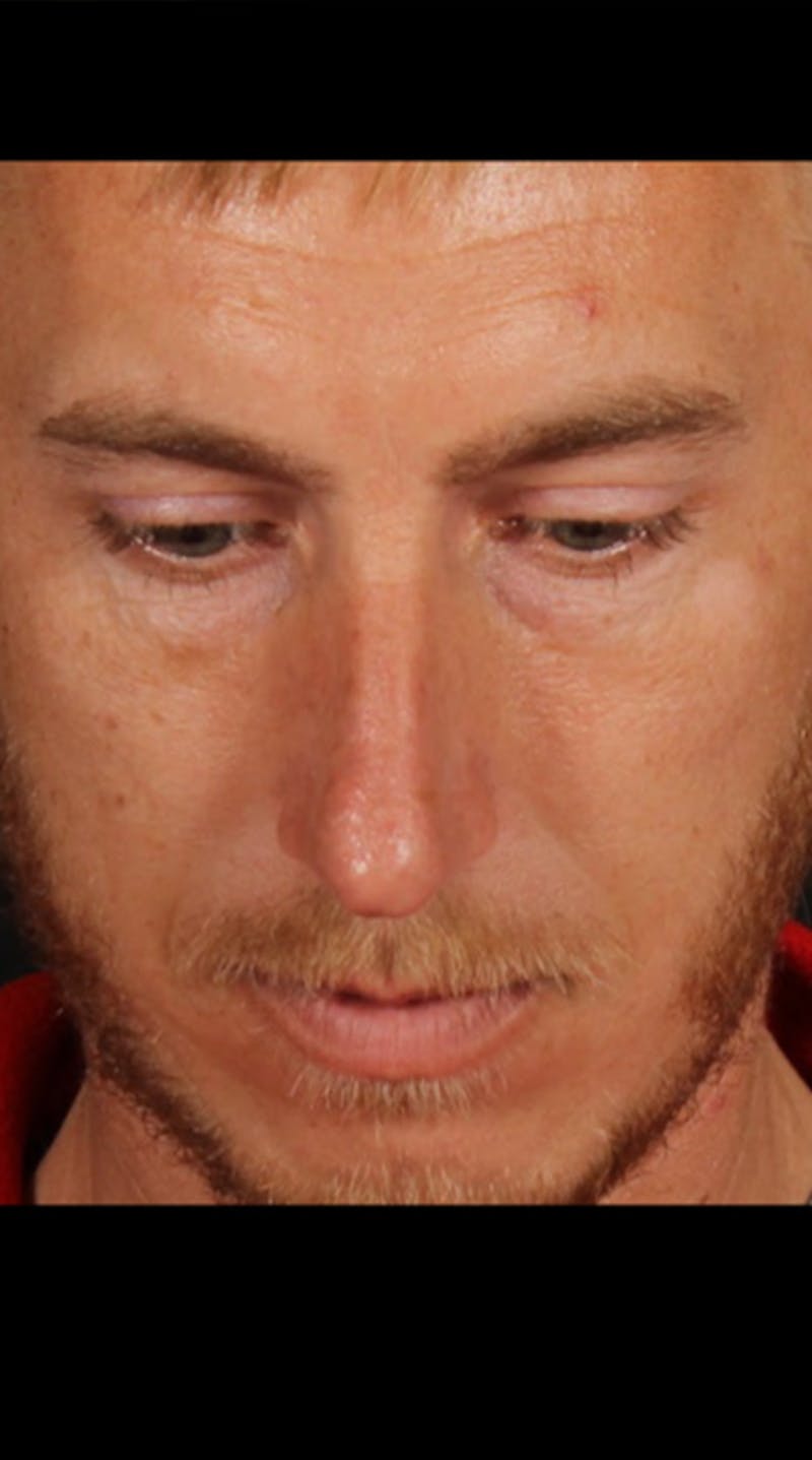 Rhinoplasty Male Before & After Gallery - Patient 418142 - Image 11