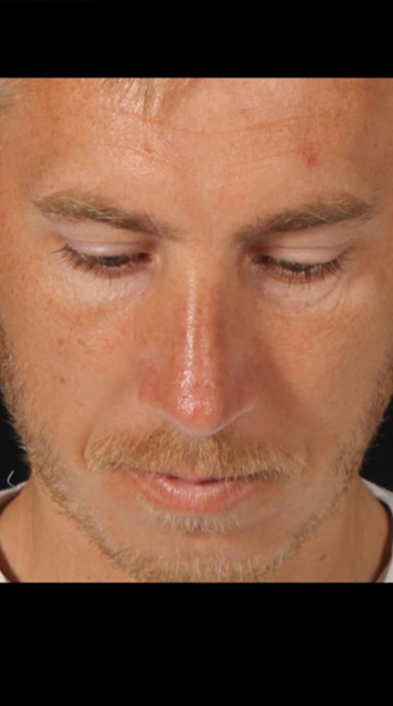 Rhinoplasty Male Before & After Gallery - Patient 418142 - Image 12