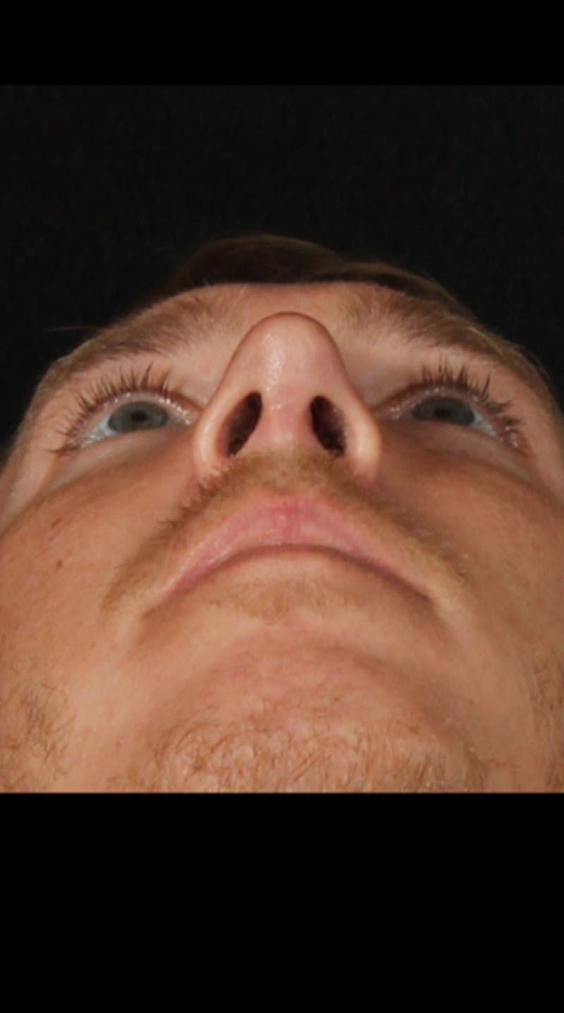 Rhinoplasty Male Before & After Gallery - Patient 418142 - Image 14