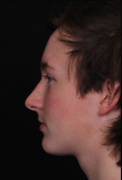 Rhinoplasty Male Before & After Gallery - Patient 972717 - Image 1
