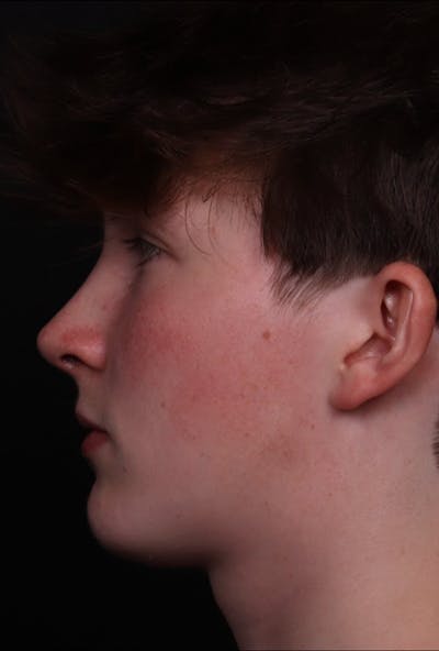 Rhinoplasty Male Before & After Gallery - Patient 972717 - Image 2