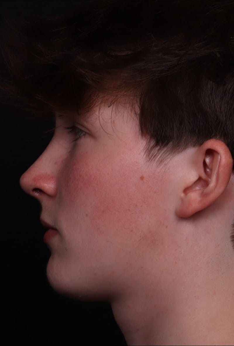 Rhinoplasty Male Before & After Gallery - Patient 972717 - Image 2
