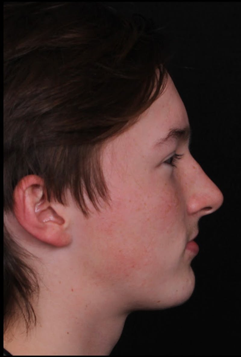 Rhinoplasty Male Before & After Gallery - Patient 972717 - Image 3