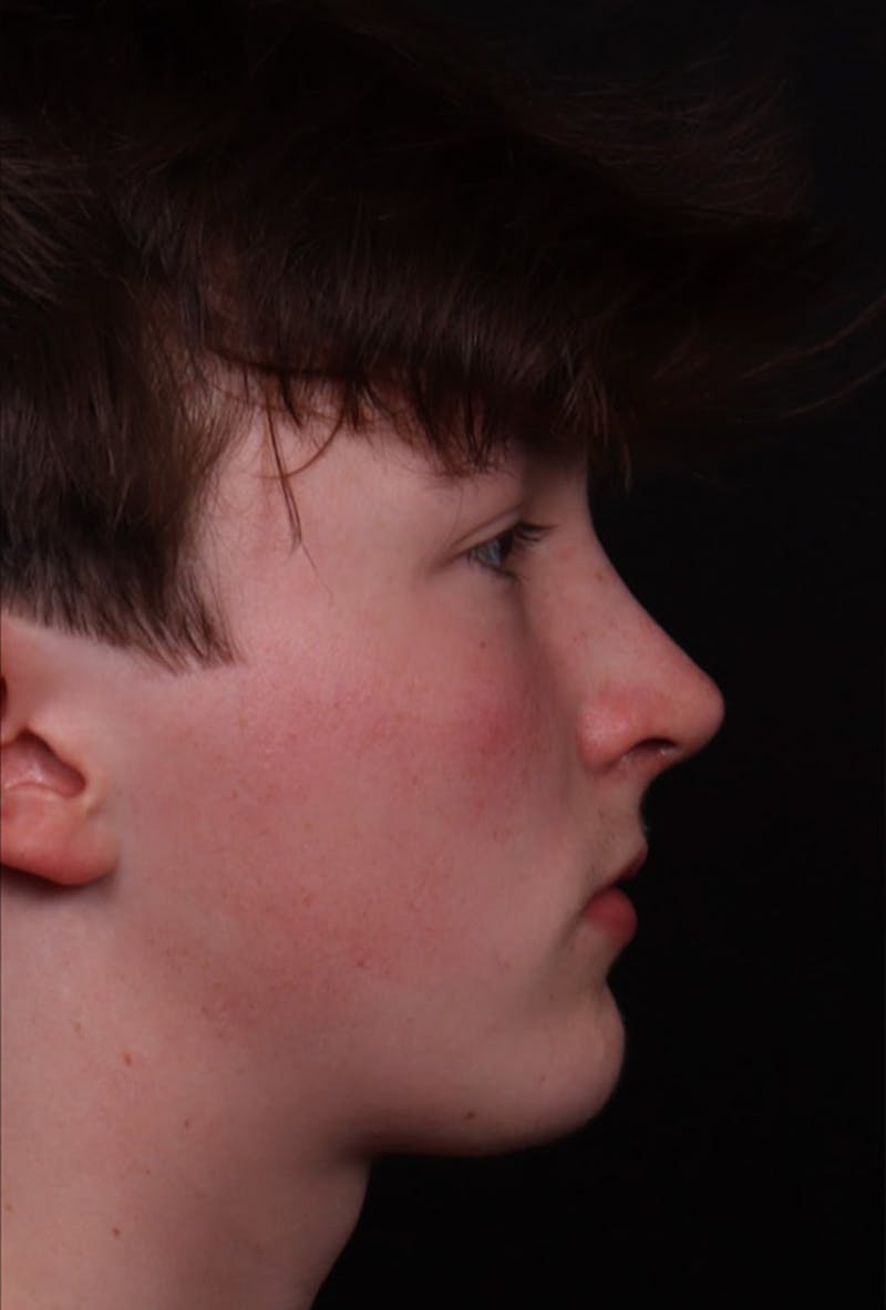 Rhinoplasty Male Before & After Gallery - Patient 972717 - Image 4