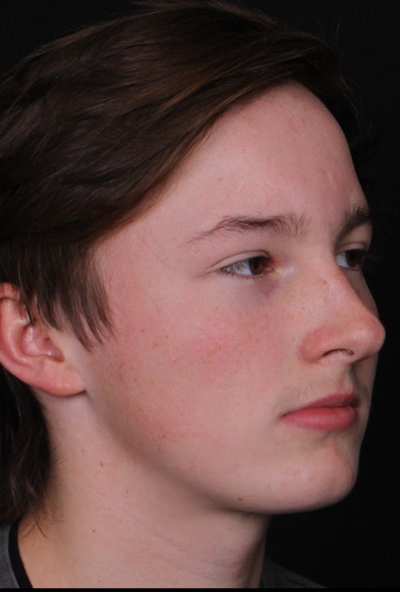 Rhinoplasty Male Before & After Gallery - Patient 972717 - Image 5