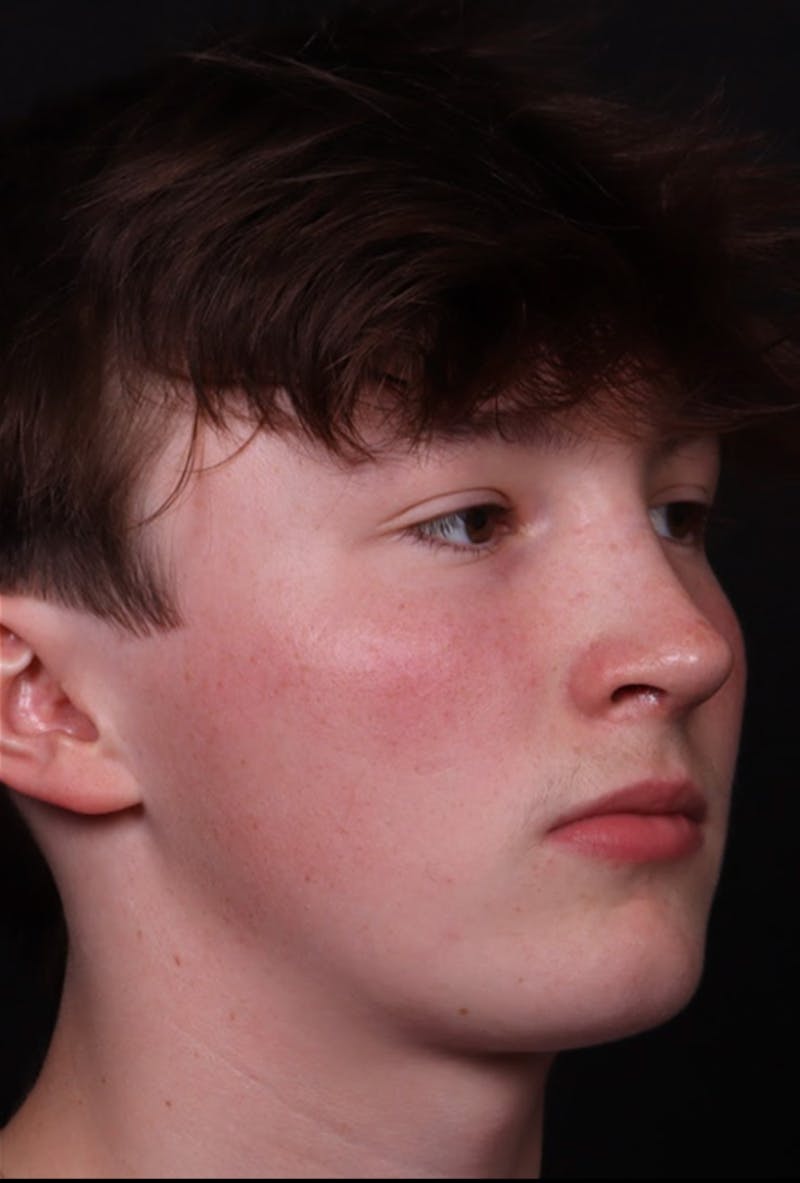 Rhinoplasty Male Before & After Gallery - Patient 972717 - Image 6