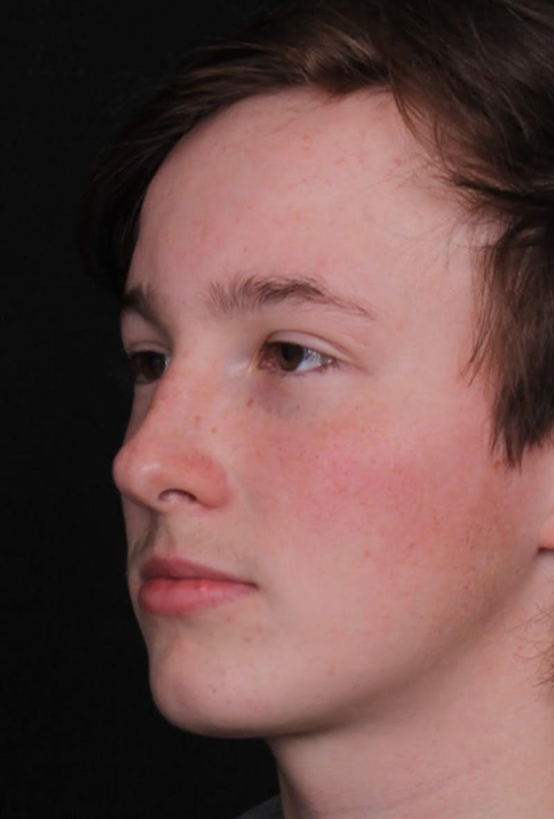 Rhinoplasty Male Before & After Gallery - Patient 972717 - Image 7