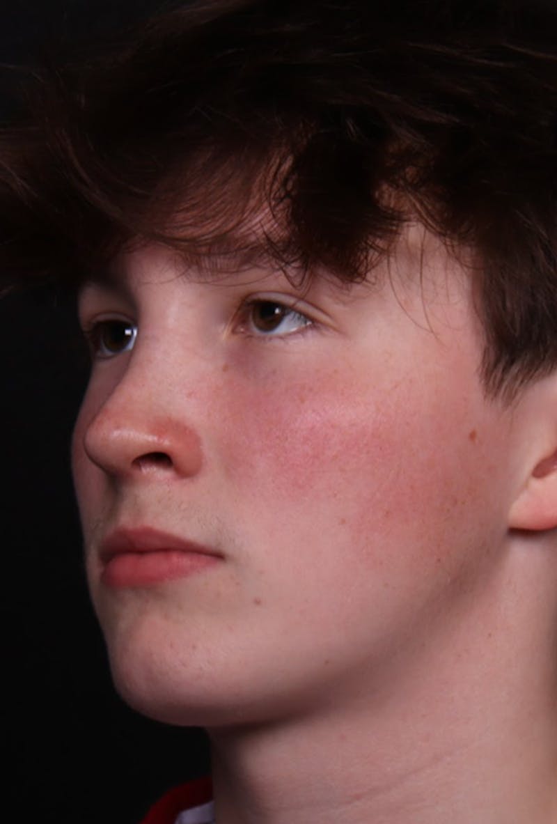 Rhinoplasty Male Before & After Gallery - Patient 972717 - Image 8