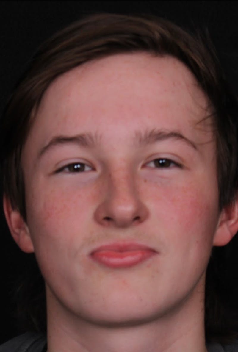 Rhinoplasty Male Before & After Gallery - Patient 972717 - Image 9