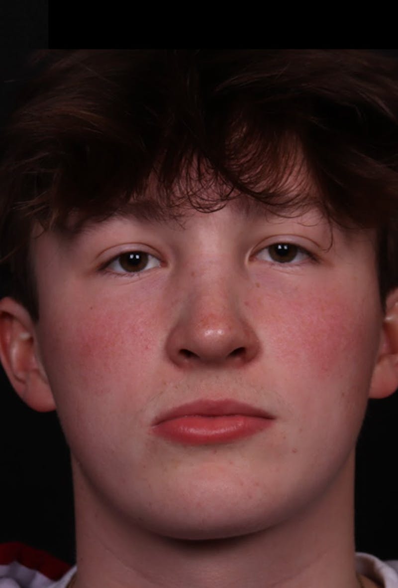 Rhinoplasty Male Before & After Gallery - Patient 972717 - Image 10