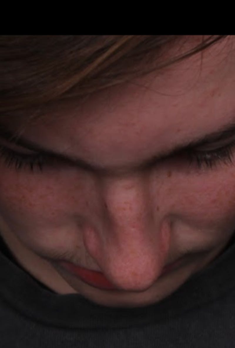 Rhinoplasty Male Before & After Gallery - Patient 972717 - Image 11