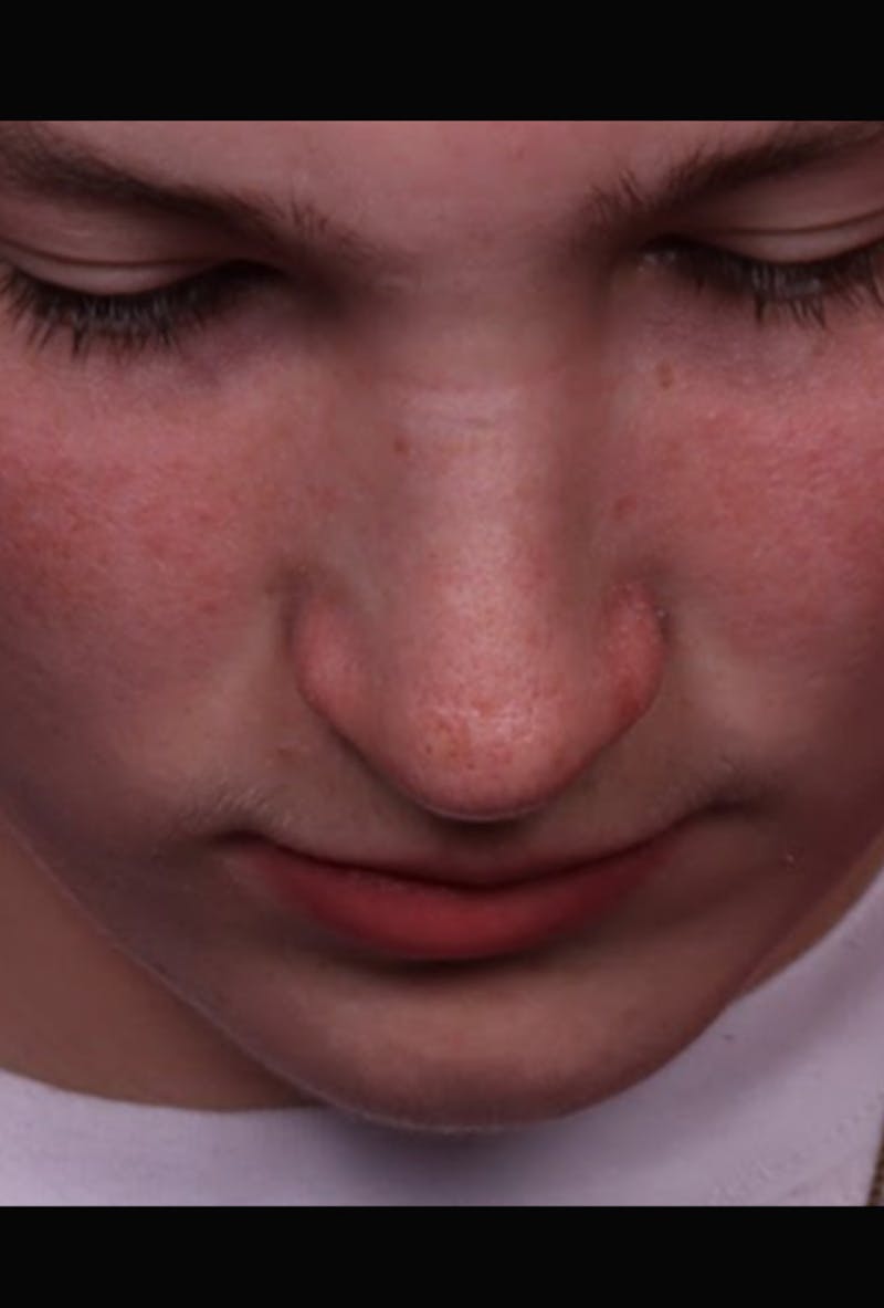 Rhinoplasty Male Before & After Gallery - Patient 972717 - Image 12