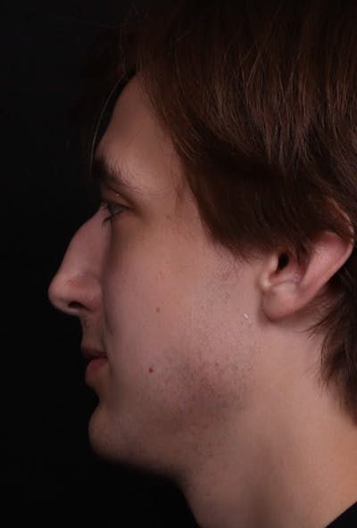 Rhinoplasty Male Before & After Gallery - Patient 358854 - Image 1