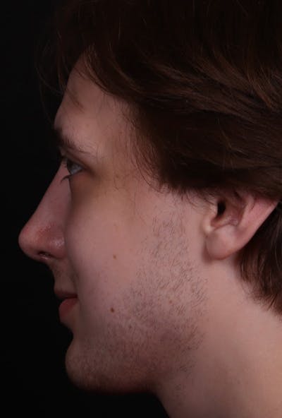 Rhinoplasty Male Before & After Gallery - Patient 358854 - Image 2