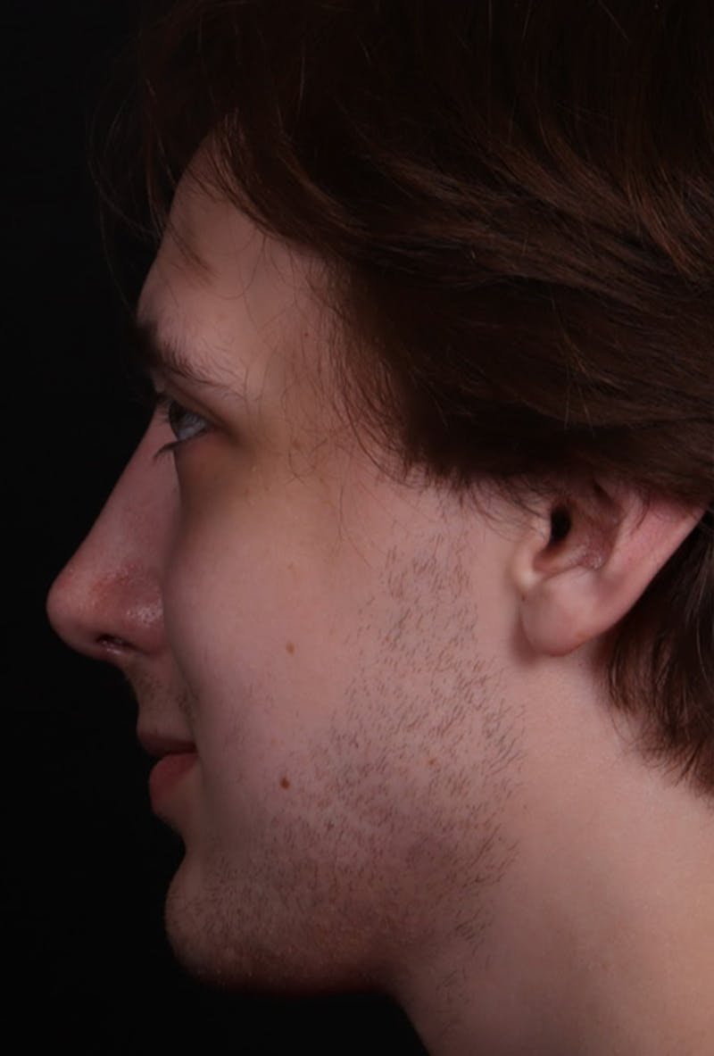 Rhinoplasty Male Before & After Gallery - Patient 358854 - Image 2