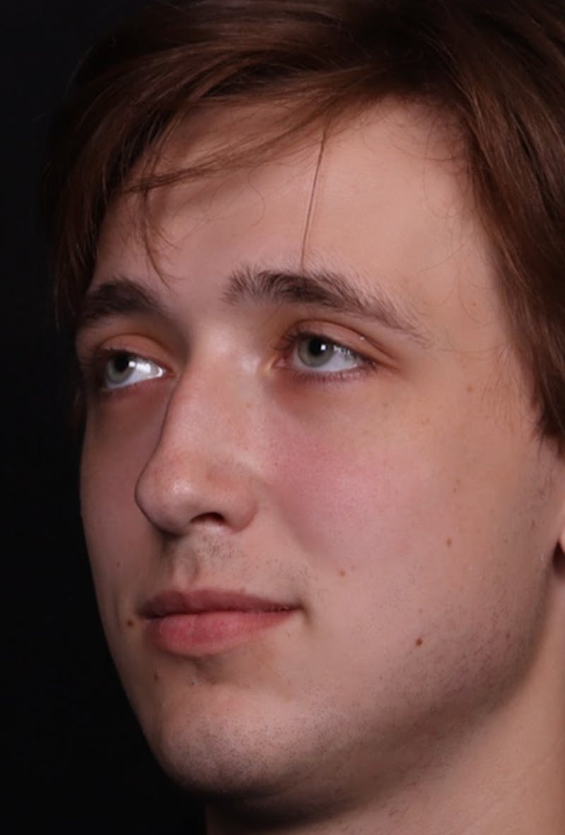 Rhinoplasty Male Before & After Gallery - Patient 358854 - Image 3