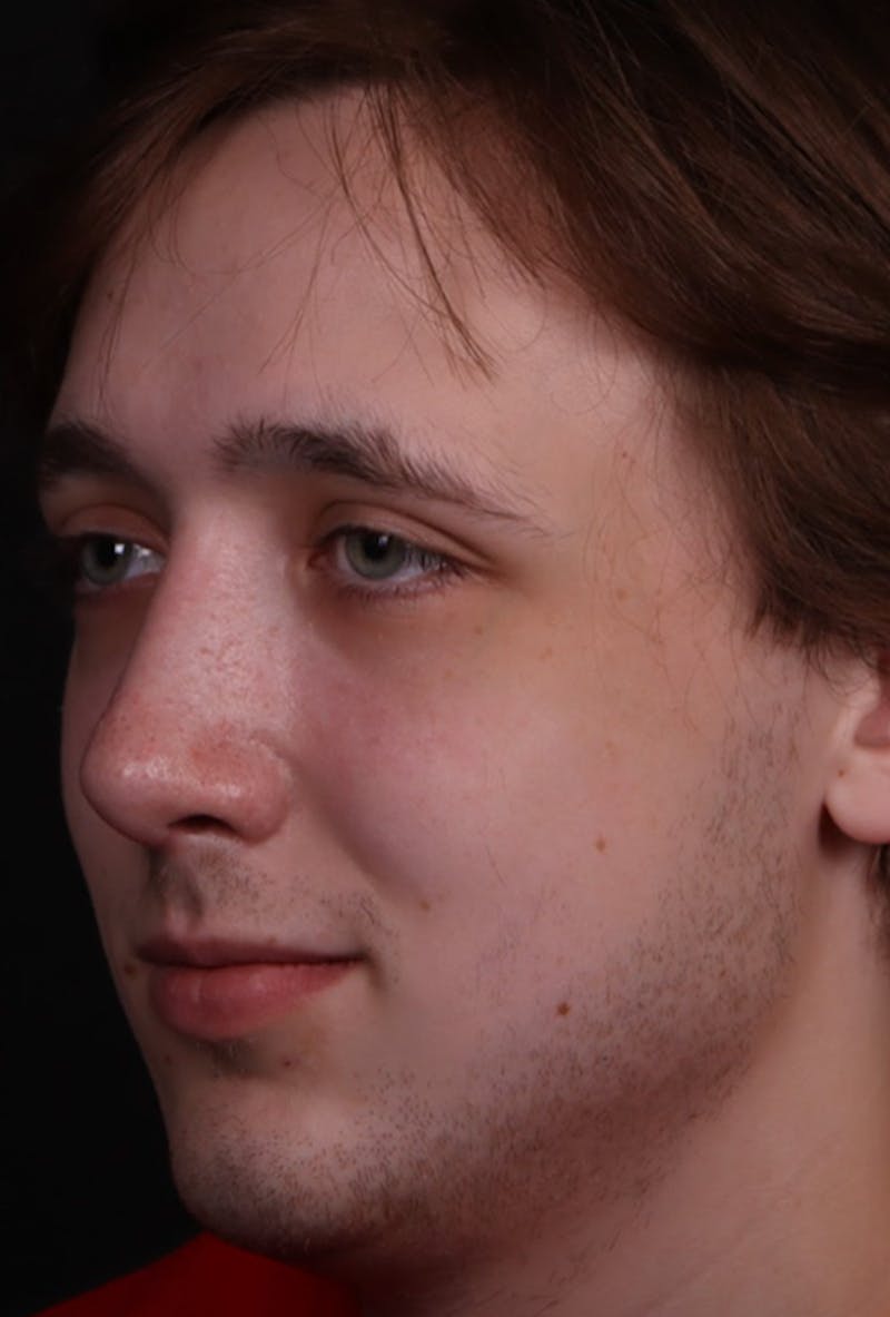 Rhinoplasty Male Before & After Gallery - Patient 358854 - Image 4