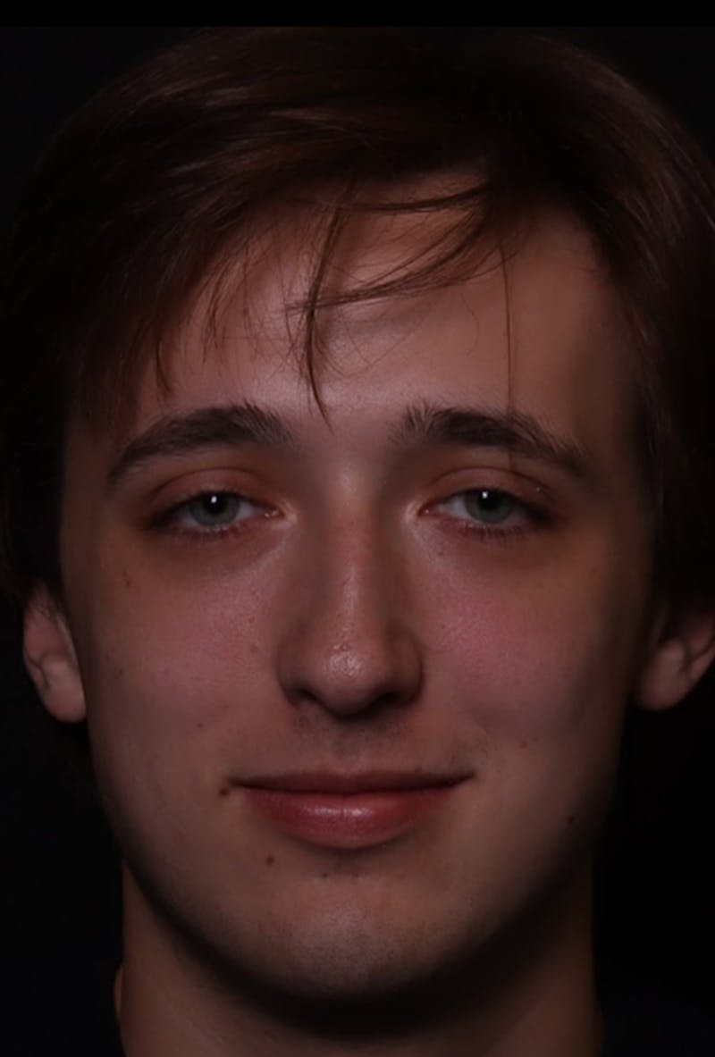 Rhinoplasty Male Before & After Gallery - Patient 358854 - Image 5