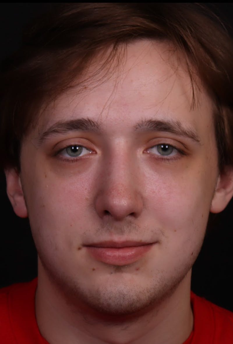 Rhinoplasty Male Before & After Gallery - Patient 358854 - Image 6