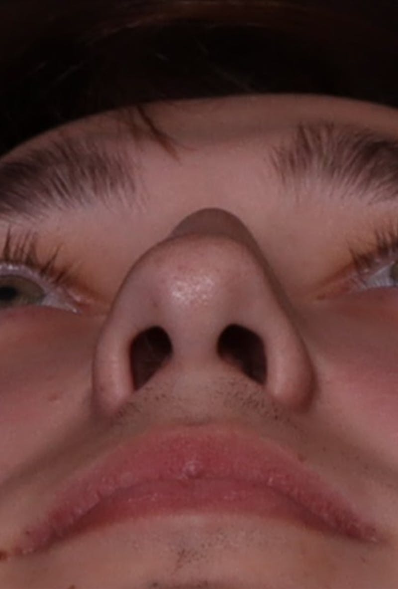 Rhinoplasty Male Before & After Gallery - Patient 358854 - Image 7