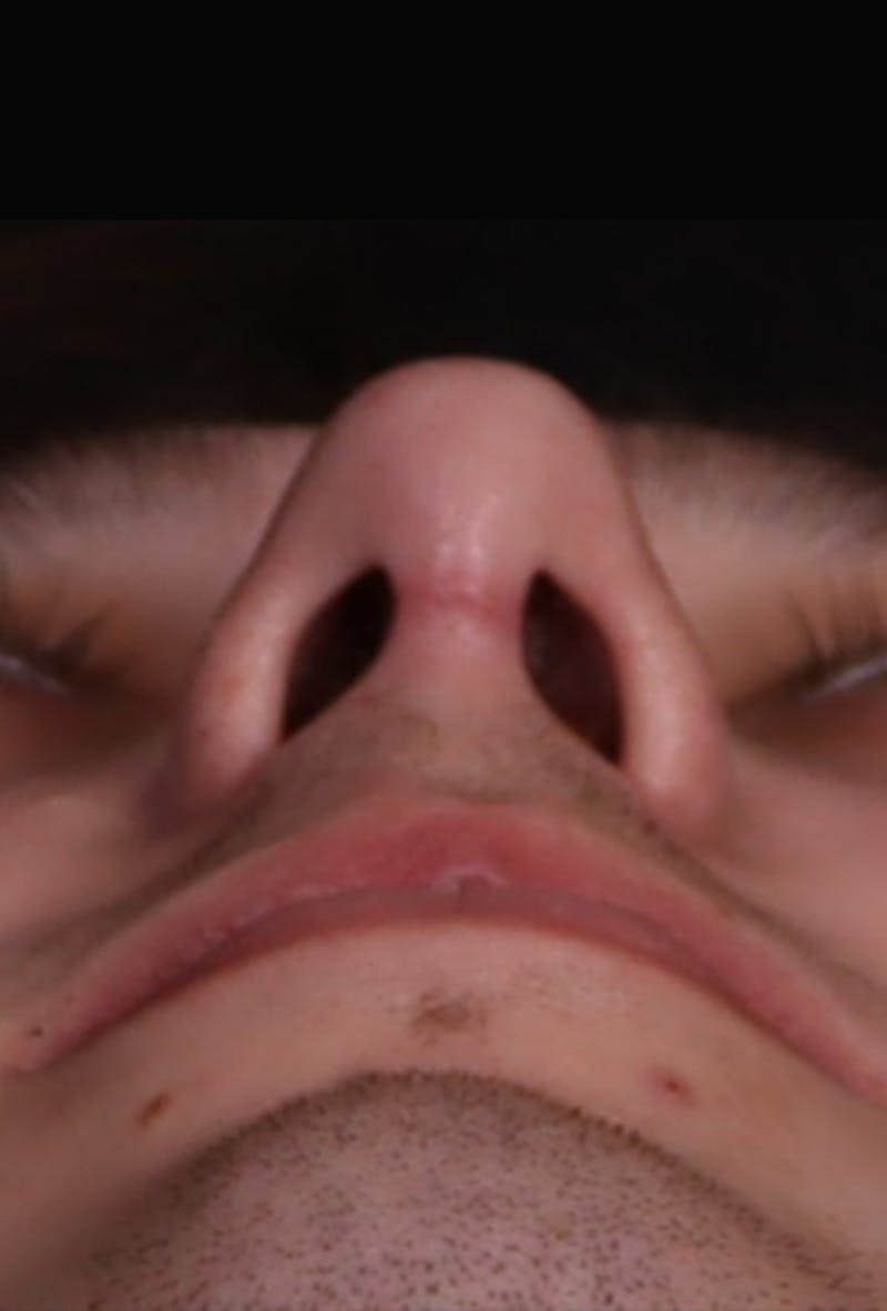 Rhinoplasty Male Before & After Gallery - Patient 358854 - Image 8