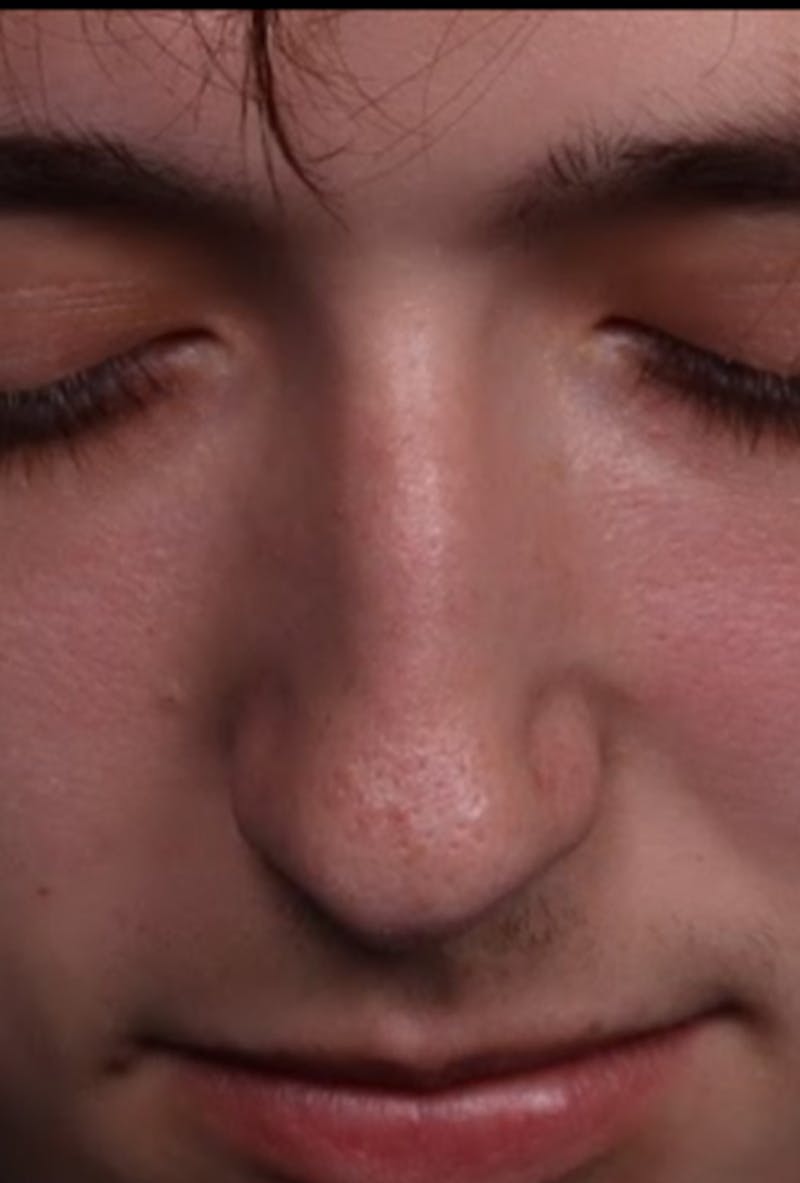 Rhinoplasty Male Before & After Gallery - Patient 358854 - Image 9