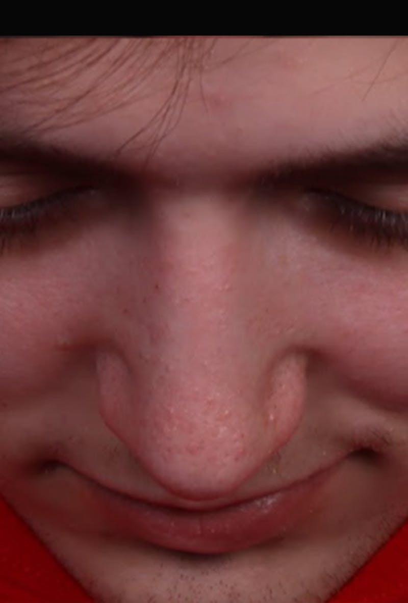 Rhinoplasty Male Before & After Gallery - Patient 358854 - Image 10