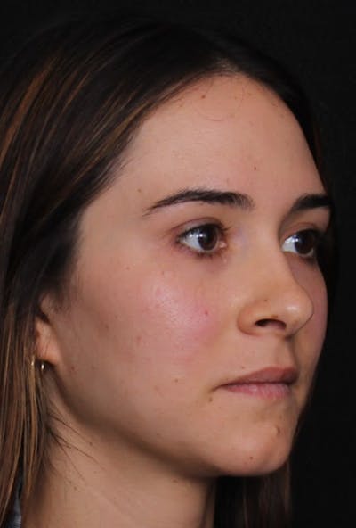 Rhinoplasty Female Before & After Gallery - Patient 750025 - Image 1