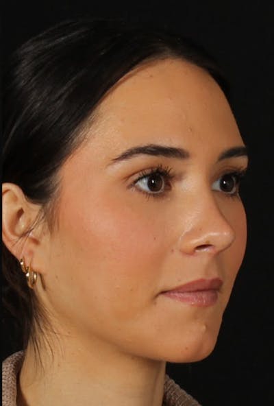 Rhinoplasty Female Before & After Gallery - Patient 750025 - Image 2