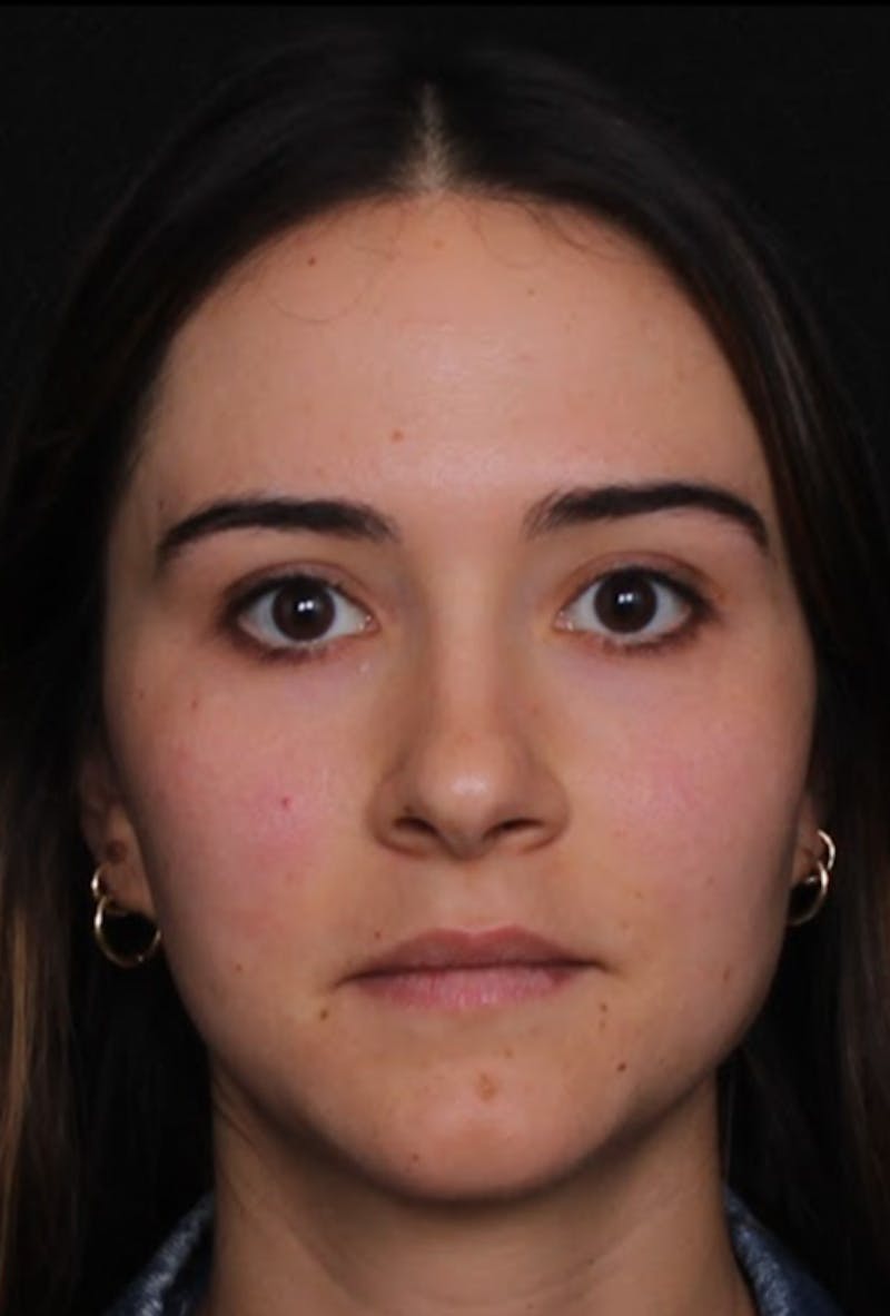 Rhinoplasty Female Before & After Gallery - Patient 750025 - Image 3