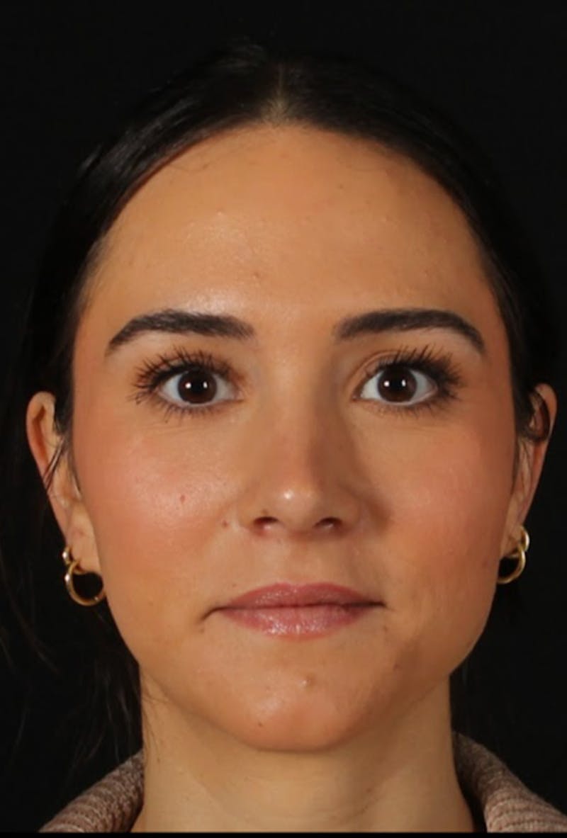 Rhinoplasty Female Before & After Gallery - Patient 750025 - Image 4