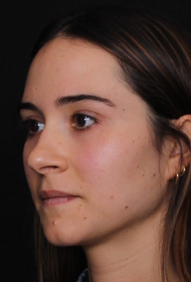 Rhinoplasty Female Before & After Gallery - Patient 750025 - Image 5