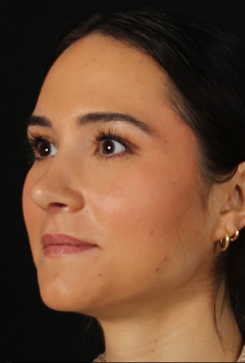 Rhinoplasty Female Before & After Gallery - Patient 750025 - Image 6