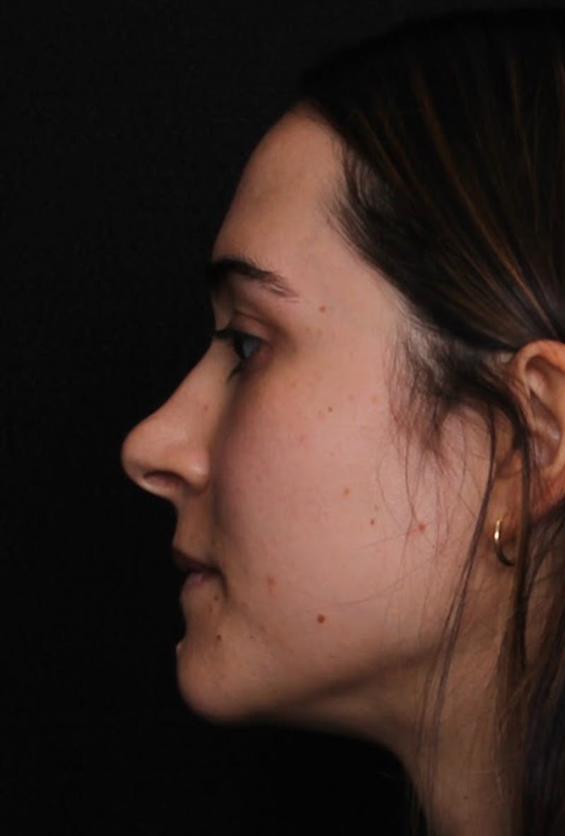 Rhinoplasty Female Before & After Gallery - Patient 750025 - Image 7