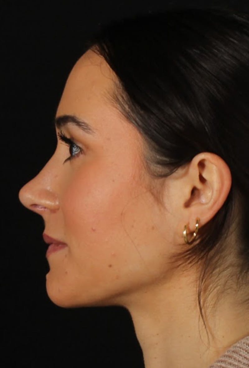 Rhinoplasty Female Before & After Gallery - Patient 750025 - Image 8