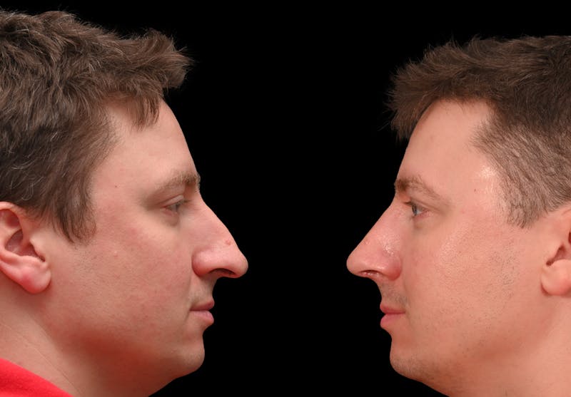 Rhinoplasty Before & After Gallery - Patient 360931 - Image 5