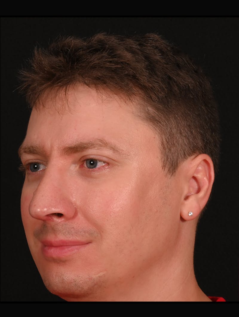 Rhinoplasty Before & After Gallery - Patient 360931 - Image 10