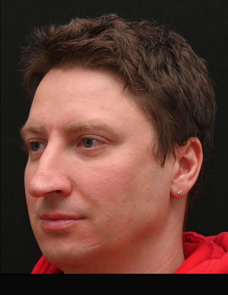 Rhinoplasty Before & After Gallery - Patient 360931 - Image 9