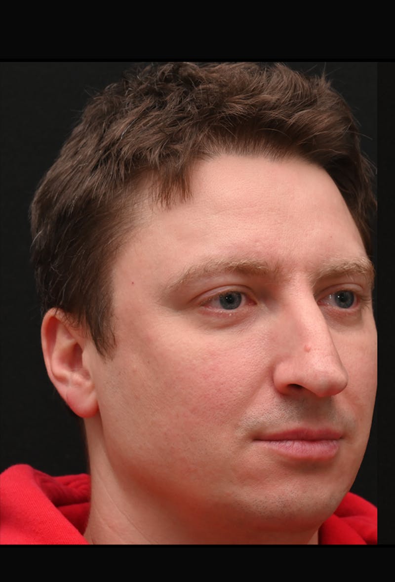 Rhinoplasty Before & After Gallery - Patient 360931 - Image 11