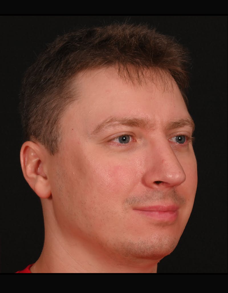 Rhinoplasty Before & After Gallery - Patient 360931 - Image 12