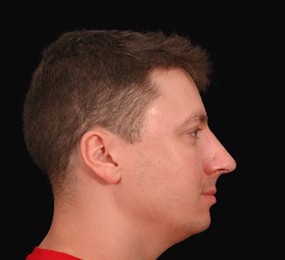 Rhinoplasty Before & After Gallery - Patient 360931 - Image 2