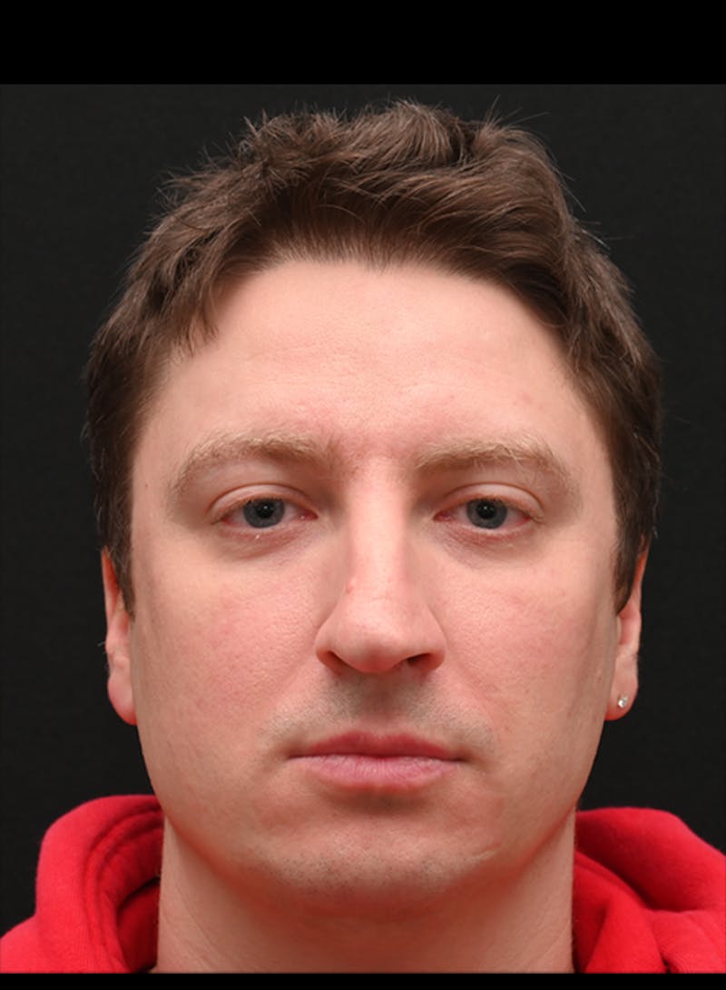 Rhinoplasty Before & After Gallery - Patient 360931 - Image 3