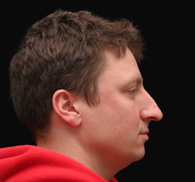 Rhinoplasty Before & After Gallery - Patient 360931 - Image 1