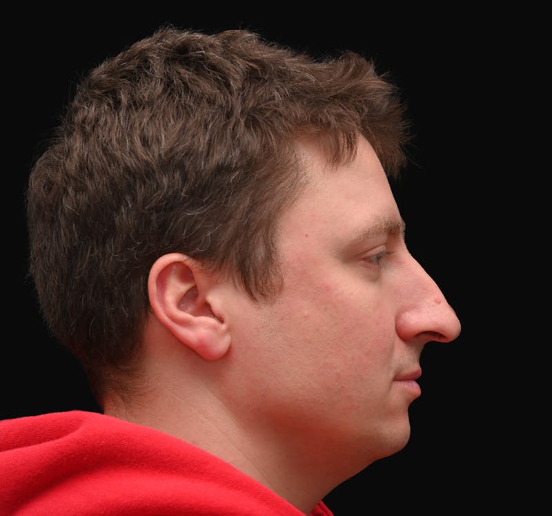 Rhinoplasty Before & After Gallery - Patient 360931 - Image 1