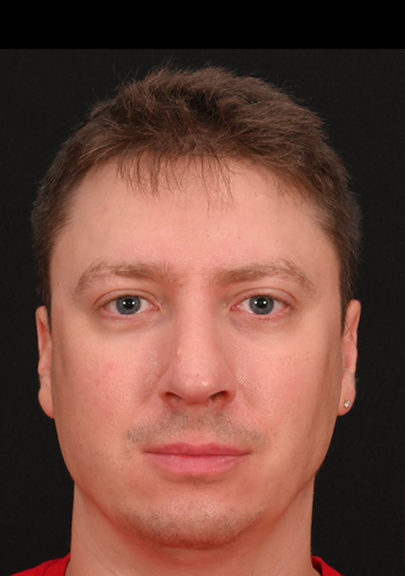 Rhinoplasty Before & After Gallery - Patient 360931 - Image 4