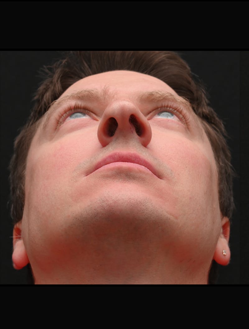 Rhinoplasty Before & After Gallery - Patient 360931 - Image 7