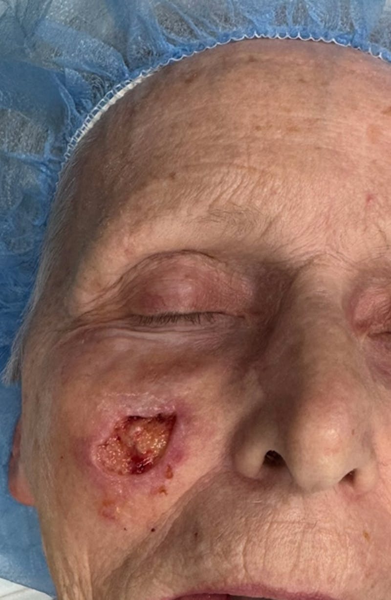 Mohs Facial Reconstruction  Before & After Gallery - Patient 182087 - Image 1
