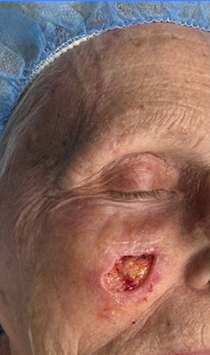 Mohs Facial Reconstruction  Before & After Gallery - Patient 182087 - Image 3