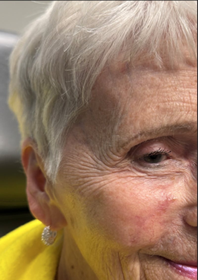 Mohs Facial Reconstruction  Before & After Gallery - Patient 182087 - Image 4