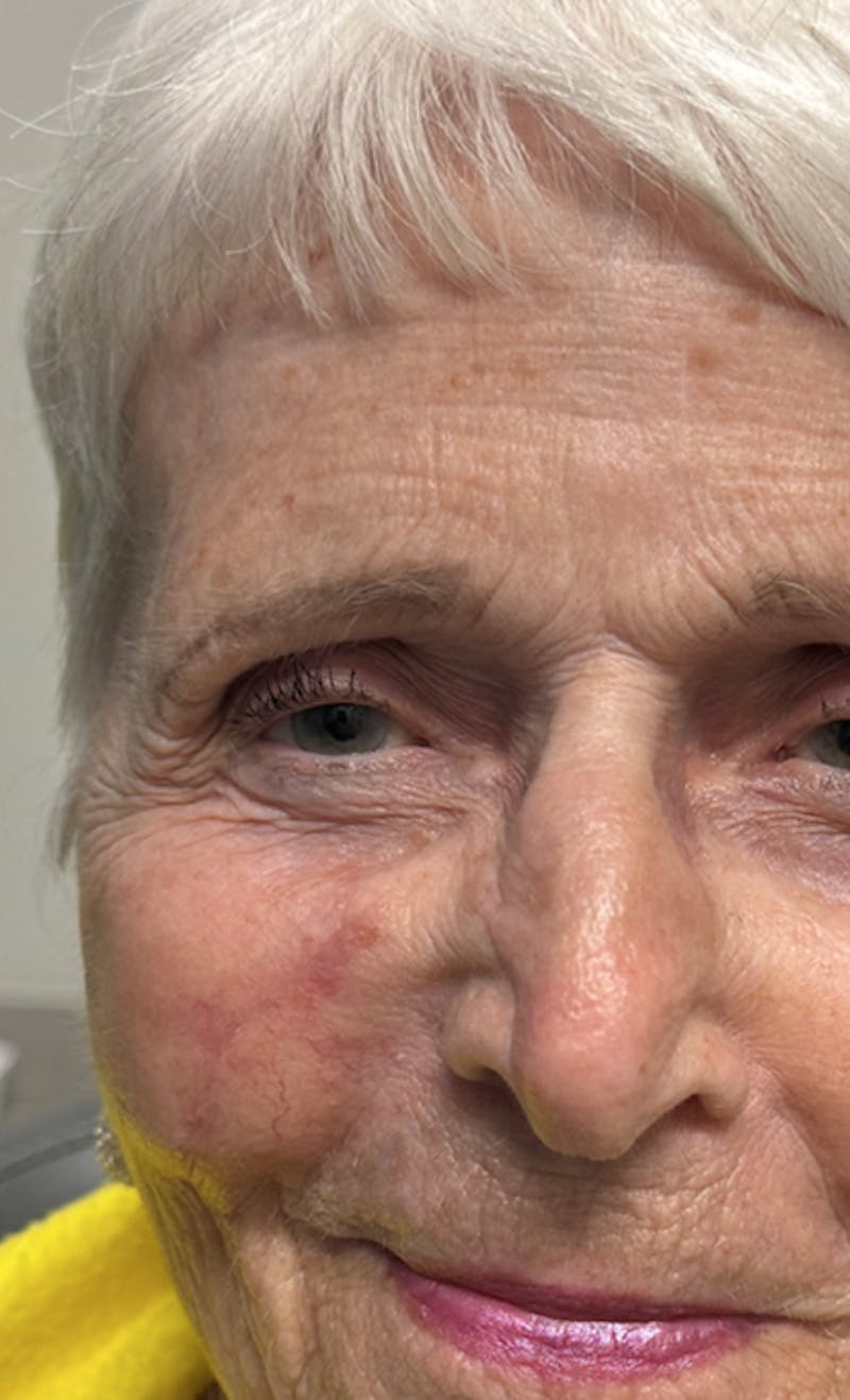 Mohs Facial Reconstruction  Before & After Gallery - Patient 182087 - Image 2
